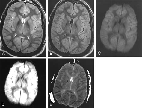 50 Anoxic Brain Injury Hypoxic Ischemic Encephalopathy Mri Us