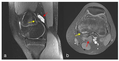 Jcm Free Full Text Cortical Desmoid Of The Distal Femur