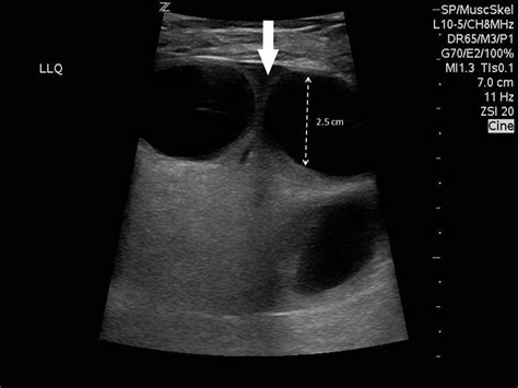 Ventral Hernia Ultrasound