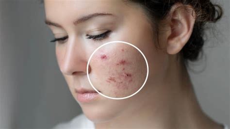 Safe And Quick Treatments For Blood Pimples Get Rid Of Them