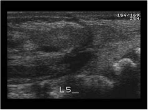 Neonatalinfant Spine Sonographic Tendencies