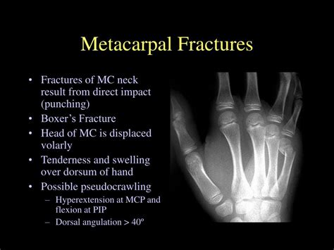 Ppt Management Of Extremity Fractures Powerpoint Presentation Free