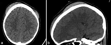 Subgaleal Hematoma Evacuation In A Pediatric Patient A Case Report And