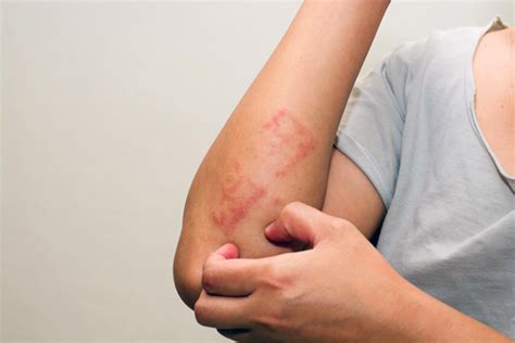 Dermatite Da Sudore Sintomi Trattamenti E Prevenzione Akoa