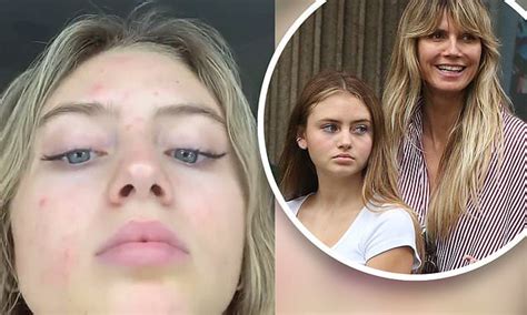 Heidi Klums Daughter Leni 16 Gets Real About Her Acne As She Reveals Her Bad Skin On Instagram