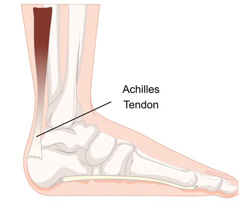 What Is Achilles Tendinopathy Insoles And Orthotics Healthy Step