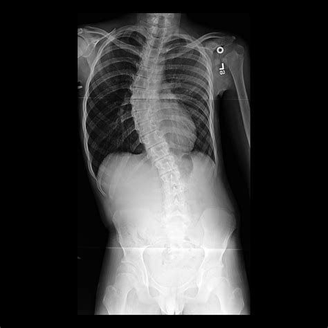 Neuromuscular Scoliosis Pediatric Radiology Reference Article