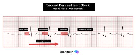 Atrioventricular Block Heart Block Geeky Medics