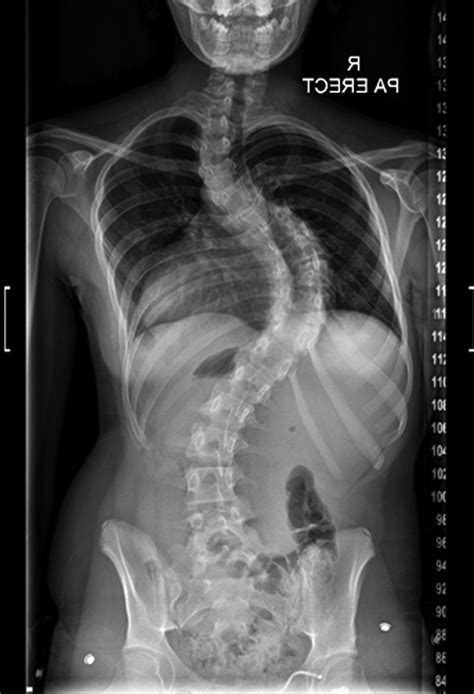 References In The 10 Key Steps For Radiographic Analysis Of Adolescent Idiopathic Scoliosis