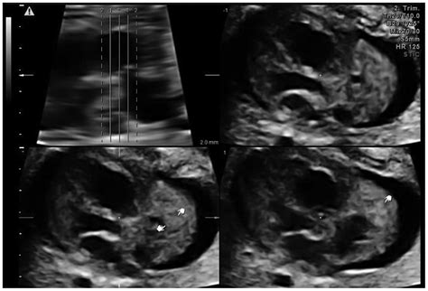 Right Atrial Cardiac Rhabdomyoma With Premature Foramen Ovale