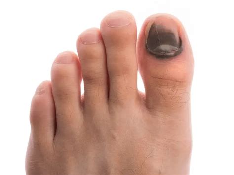 Black Toenail 5 Common Causes And Treatment A Helpful Guide
