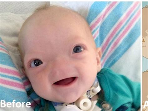 This Baby With No Nose Is The Cutest Baby You Will Ever Seen In Your