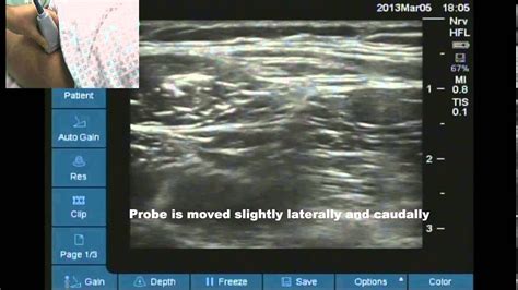 Ultrasound Location Of Lateral Femoral Cutaneous Nerve Youtube