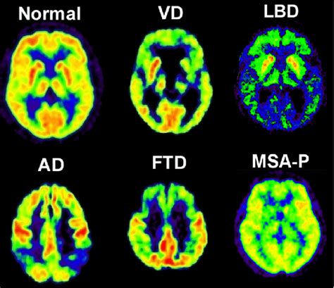 Dementia Vs Normal Brain Mri Scan