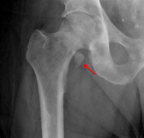 Lesser Trochanter Avulsion Fracture Therapy Fracture