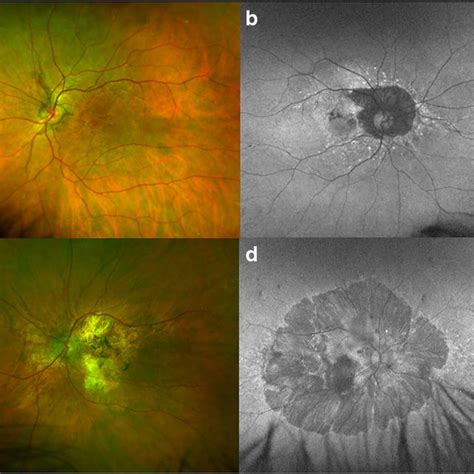 Ultra Widefield Fundus Autofluorescence Uwf Faf And Color Images Of 4