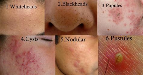 Using retinoids to treat hormonal acne. Types of Acne #HowToTreatCysticAcne #AcneScarsRemedies ...