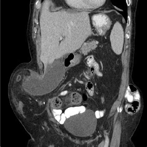 Ct From May 2017 With Decompressed Gallbladder And Unobstructed Bowel