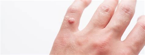 Warts On Hands And Fingers Holland And Barrett