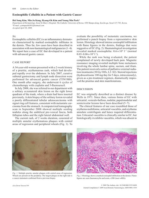 Pdf Eosinophilic Cellulitis In A Patient With Gastric Cancer