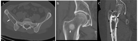 Ct Classification Of Bone Lesions By Density Ct Images Show A Lucent