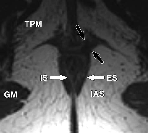 Cross Sectional Imaging Of The Anal Sphincter In Fecal Incontinence Ajr