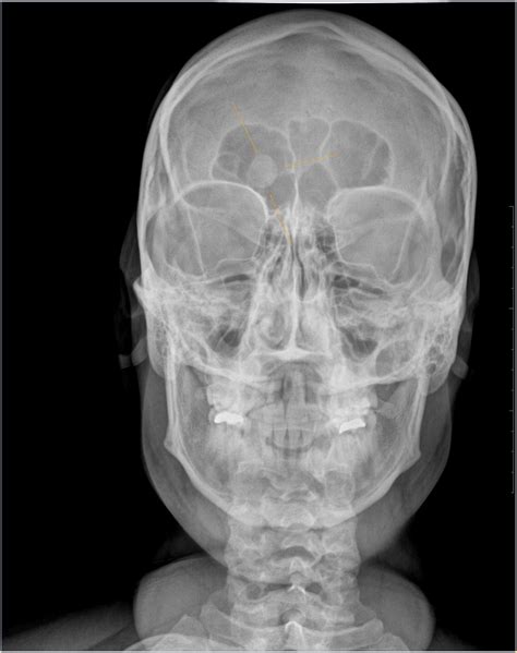 Frontal Osteoma Xray Sumers Radiology Blog