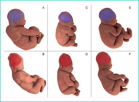 3d Images Show How Babys Head Changes Shape During Birth