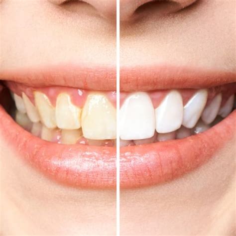 Buck Teeth Cause And Treatment Maltepe Dental Clinic