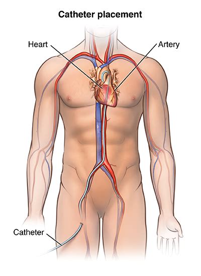 Angioplasty And Stent Placement For The Heart Health