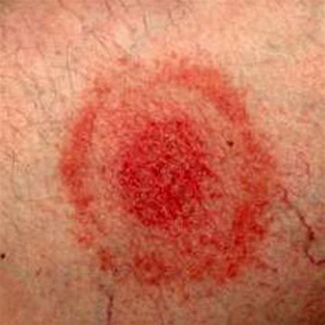 Tick Bite Rash Pictures Medical Pictures And Images Updated