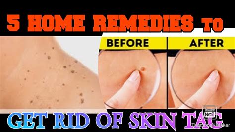 5 home remedies to get rid of skin tags youtube