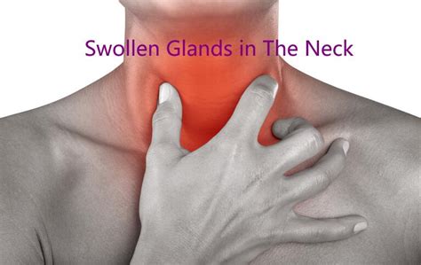 Swollen Glands In Neck 12 Common Causes With Treatment