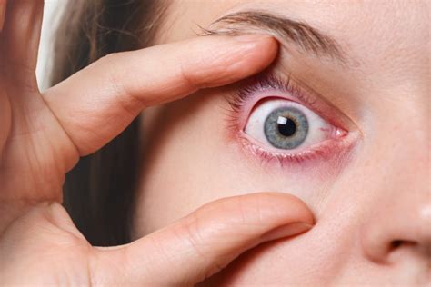5 Causes Of Swollen Eyelids How To Get Rid Of Puffy Eyelids