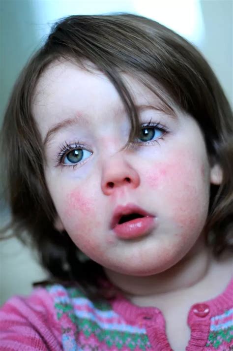 Contagious Scarlet Fever Symptoms As Helen Flanagans Children Catch
