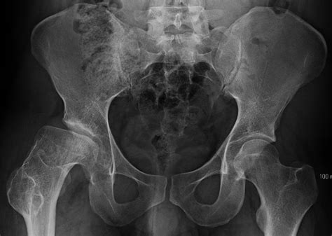 Perthes Perthes Disease Cardiff Hip Replacement Vitna Rusi