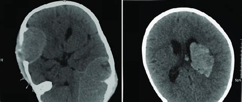 A Noncontrast Computed Tomography Head Showing Large Mass In