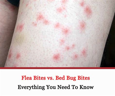 List Pictures Flea Bites On Humans Pictures Treatment Sharp