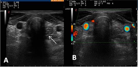 Midline Ectopic Thyroid Mimicking As A Thyroglossal Duct Cyst Manju Bala Popli Arun Chaudhary