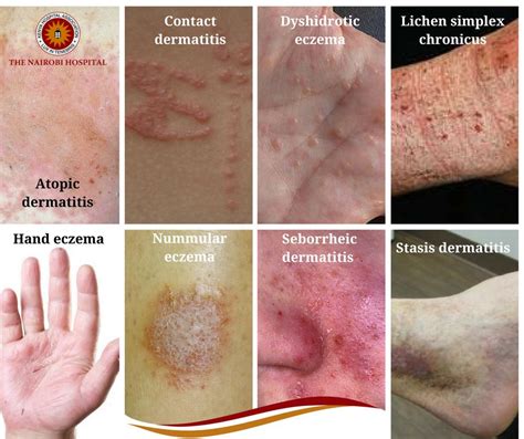 There Are Eight Types Of Eczema The Nairobi Hospital Facebook