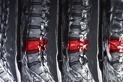 Compression Fracture Of The Spine Plainsboro Township Nj