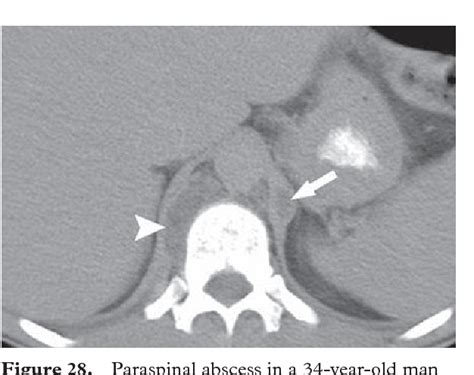 The Diaphragmatic Crura And Retrocrural Space Normal Imaging