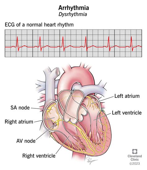 arrhythmia symptoms and treatment cardiac arrhythmias
