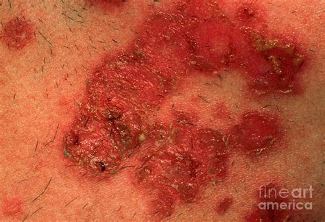 Staphylococcus Impetigo Skin Infection Photograph By Dr Chris Hale