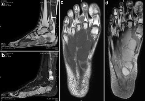 Foot Muscles Mri Accelerated Atrophy Of Lower Leg And Foot Muscles—a