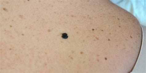 Melanoma Skin Cancer Treatment Norris Dermatology Portland Or