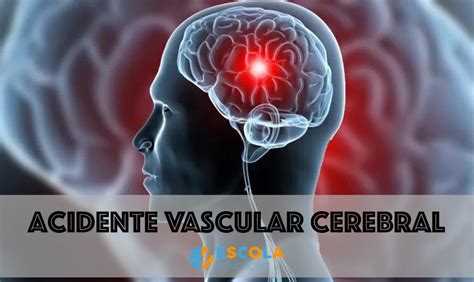 Acidente Vascular Cerebral Avc Tipos Causas Sintomas Vrogue Co