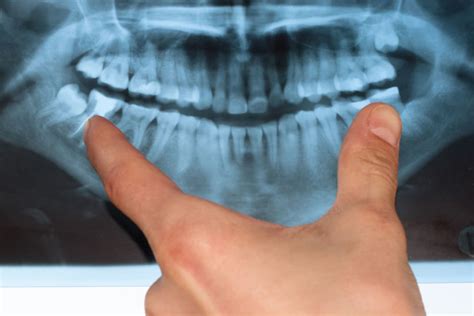 Wisdom Teeth Coming In What You Need To Know Fresno Dentist