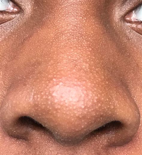 Skin Concerns How To Get Rid Of Textured Nosesmall White Heads On