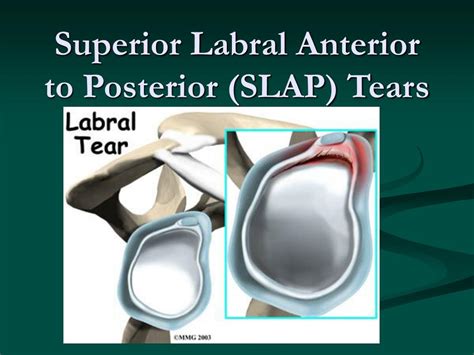 Examples Of A Type 5 Superior Labrum Anterior Posteri